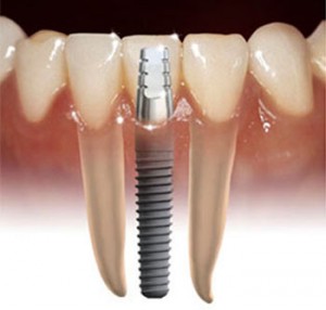 dental implants Warrenton dental implants Warrenton