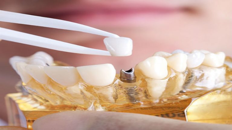 Straighten Your Smile with Invisalign Phoenix AZ: Comfort and Convenience for Adults
