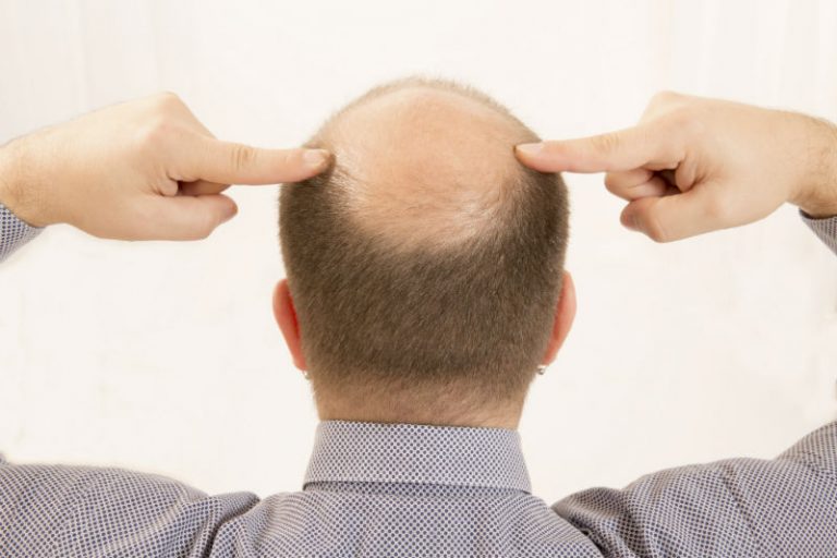 A Medical Professional Can Help New York City Residents Deal With Hair Loss