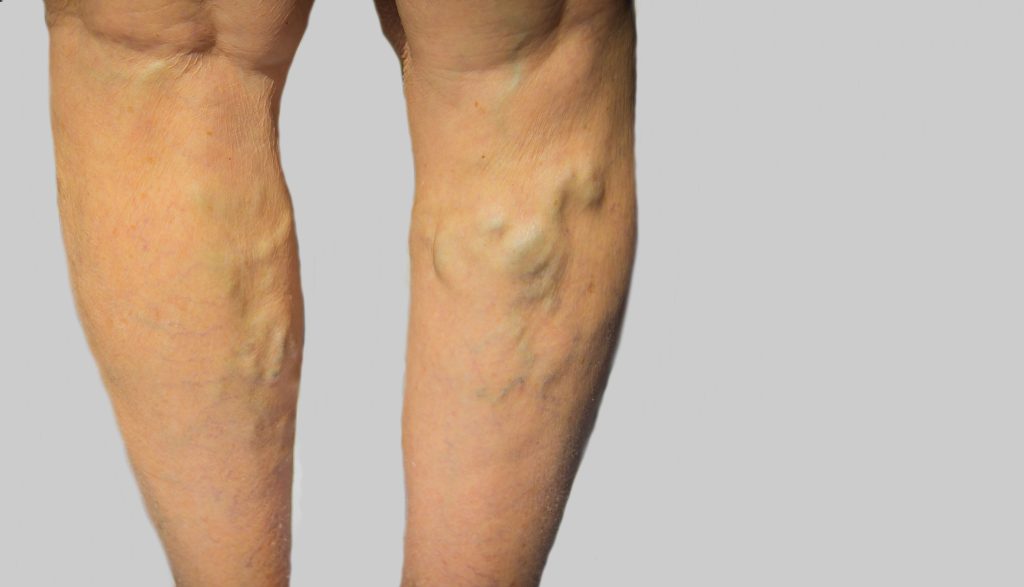 Do I Need to See a Vein Specialist in New Jersey?