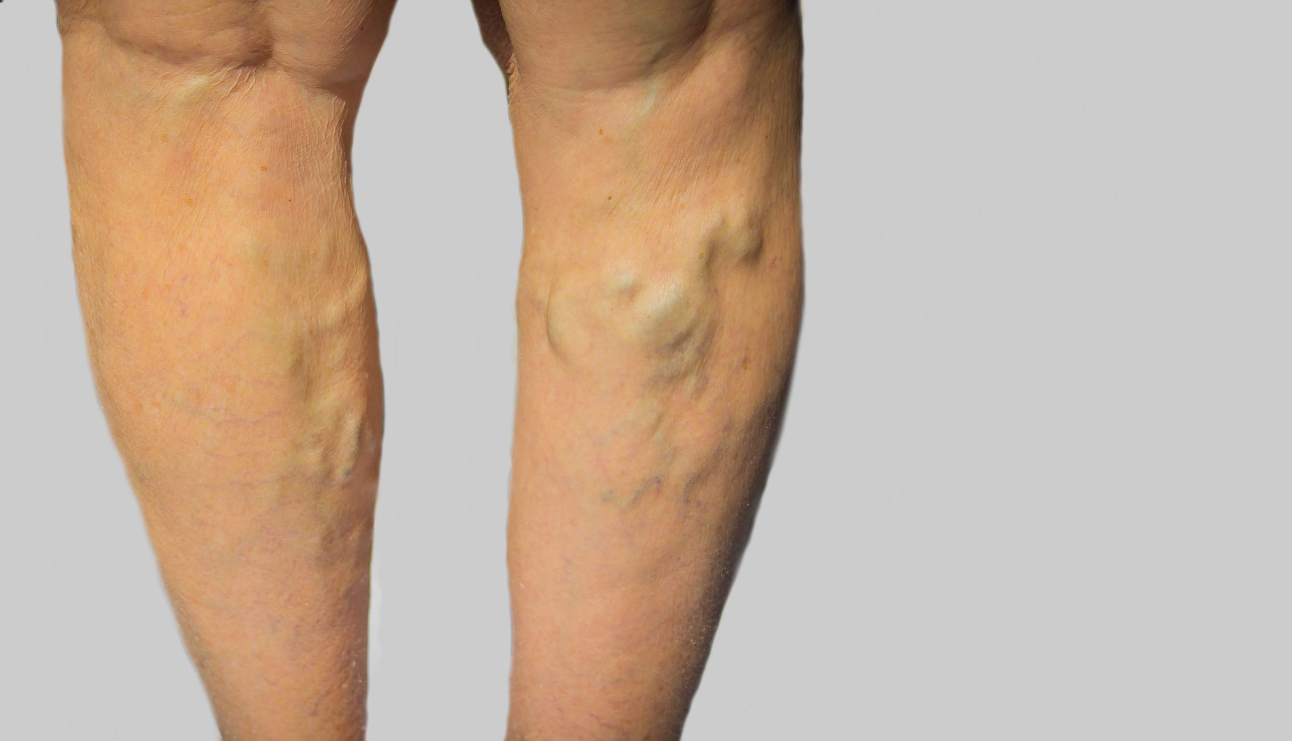 Do I Need to See a Vein Specialist in New Jersey?