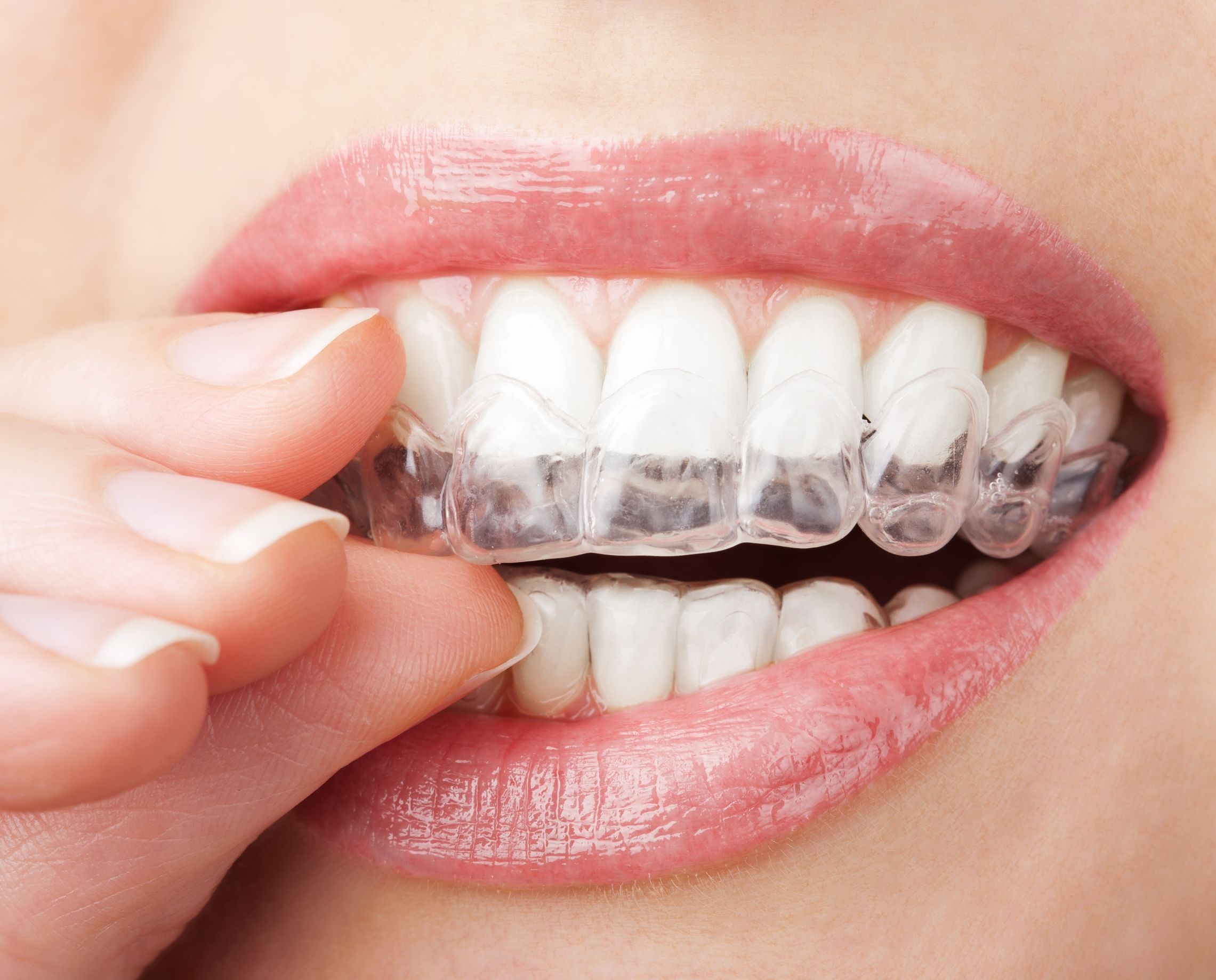 Improve Your Smile With Clear Braces For Adults In Medina OH