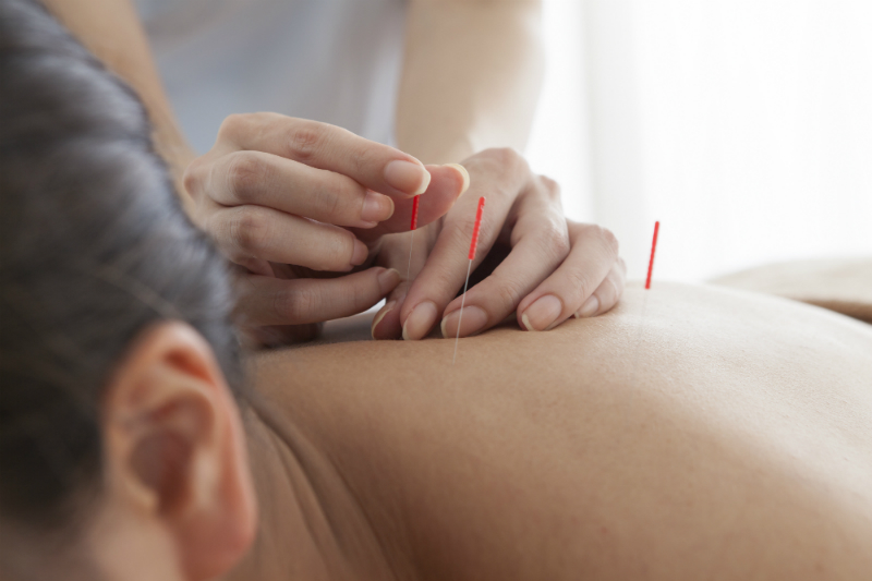Discover the Power of Acupuncture for Stress Relief in Burbank, CA