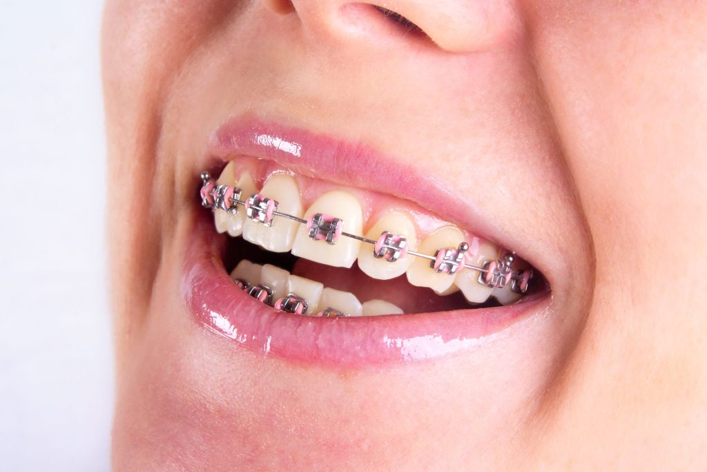 Achieve a Confident Smile with Dental Braces in Crestwood, KY, for All Ages and Lifestyles