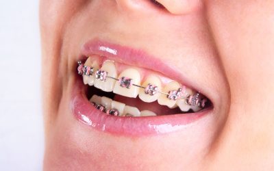 Achieve a Confident Smile with Dental Braces in Crestwood, KY, for All Ages and Lifestyles