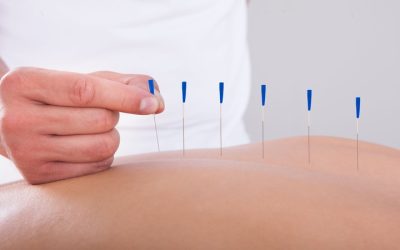 Experience Natural Pain Relief With Acupuncture In Berkeley, CA, For Lasting Wellness