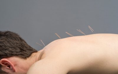 Managing Stress Naturally With Acupuncture For Anxiety In Sudden Valley, WA: Relief Methods