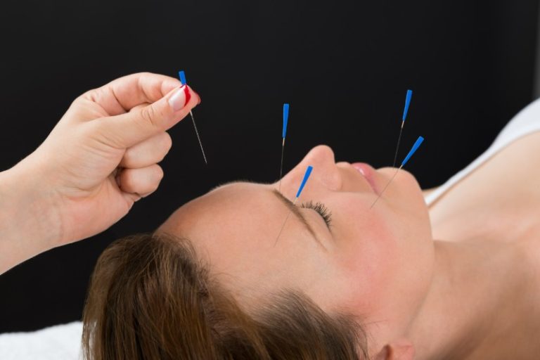 Find Lasting Relief with Acupuncture For Pain In Union City, CA, Therapy Solutions Today