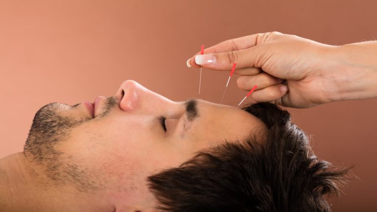 Find Natural Calm and Relief With Acupuncture For Anxiety in Sudden Valley, WA Treatments